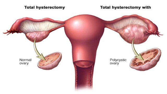 Mengenal Sindrom PCOS Penyebab, Gejala, dan Cara