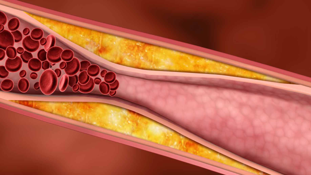 Cara Menurunkan Kolesterol Tinggi dan Asam Urat Secara Cepat dengan Pola Makan Sehat
